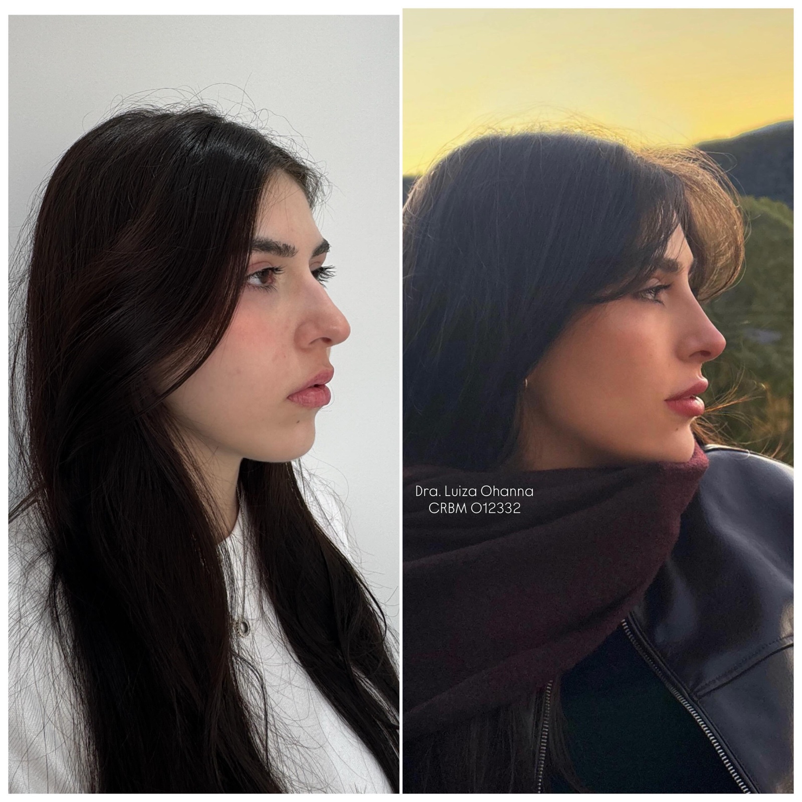Comparação de antes e depois em vista de perfil, registro 1, fornecida pela Dra. Luiza Ohanna