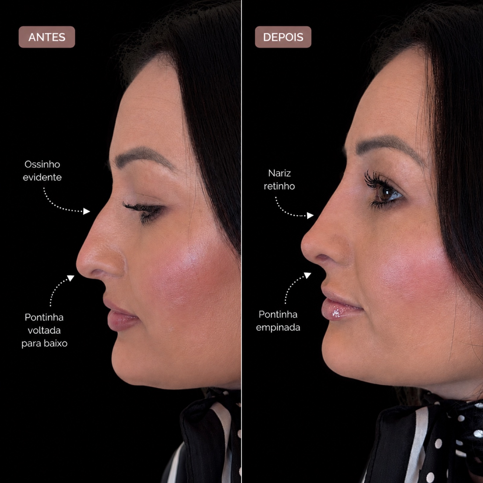 Comparação de antes e depois em vista de perfil, registro 2, fornecida pela Dra. Luiza Ohanna