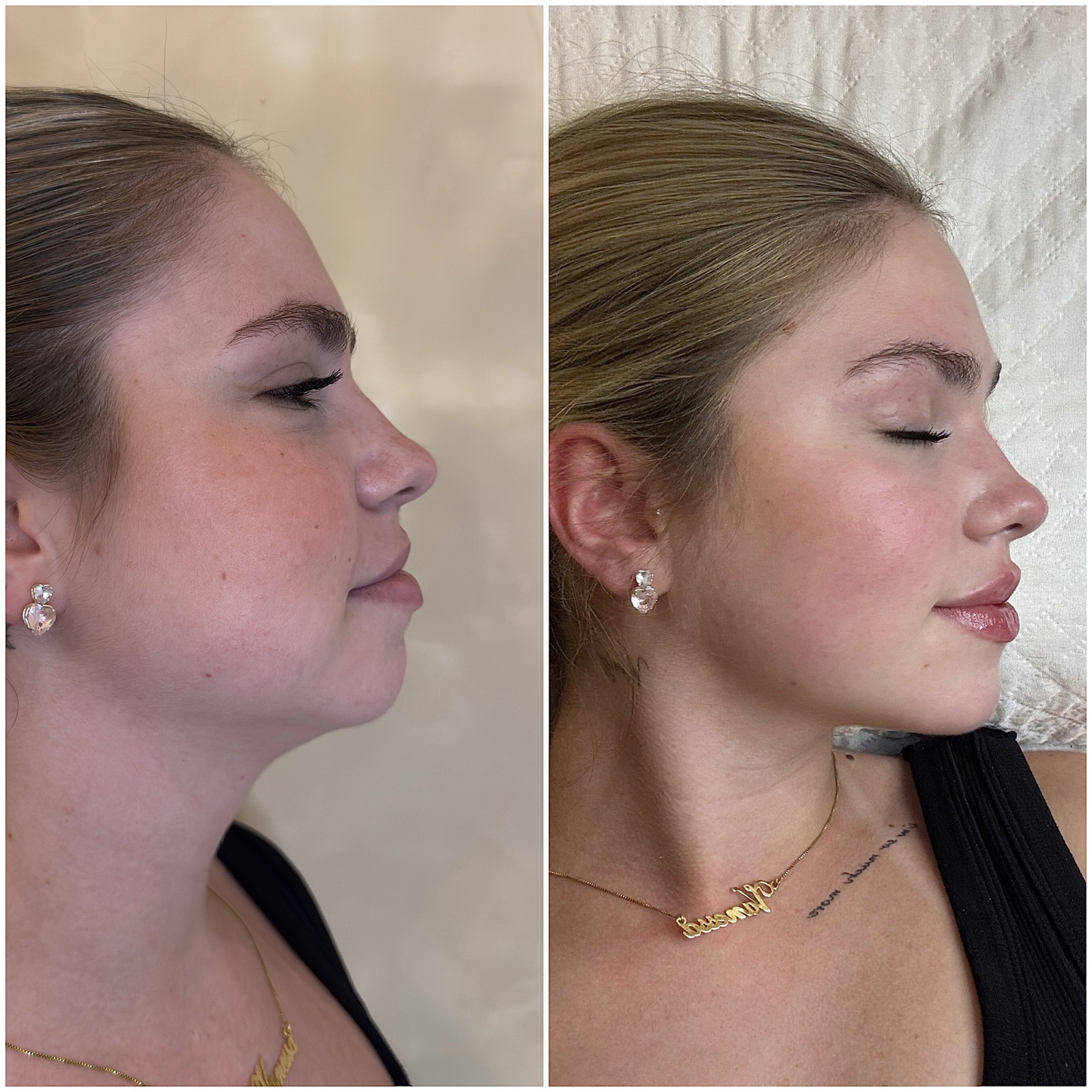 Comparação de antes e depois em vista de perfil, registro 3, fornecida pela Dra. Luiza Ohanna