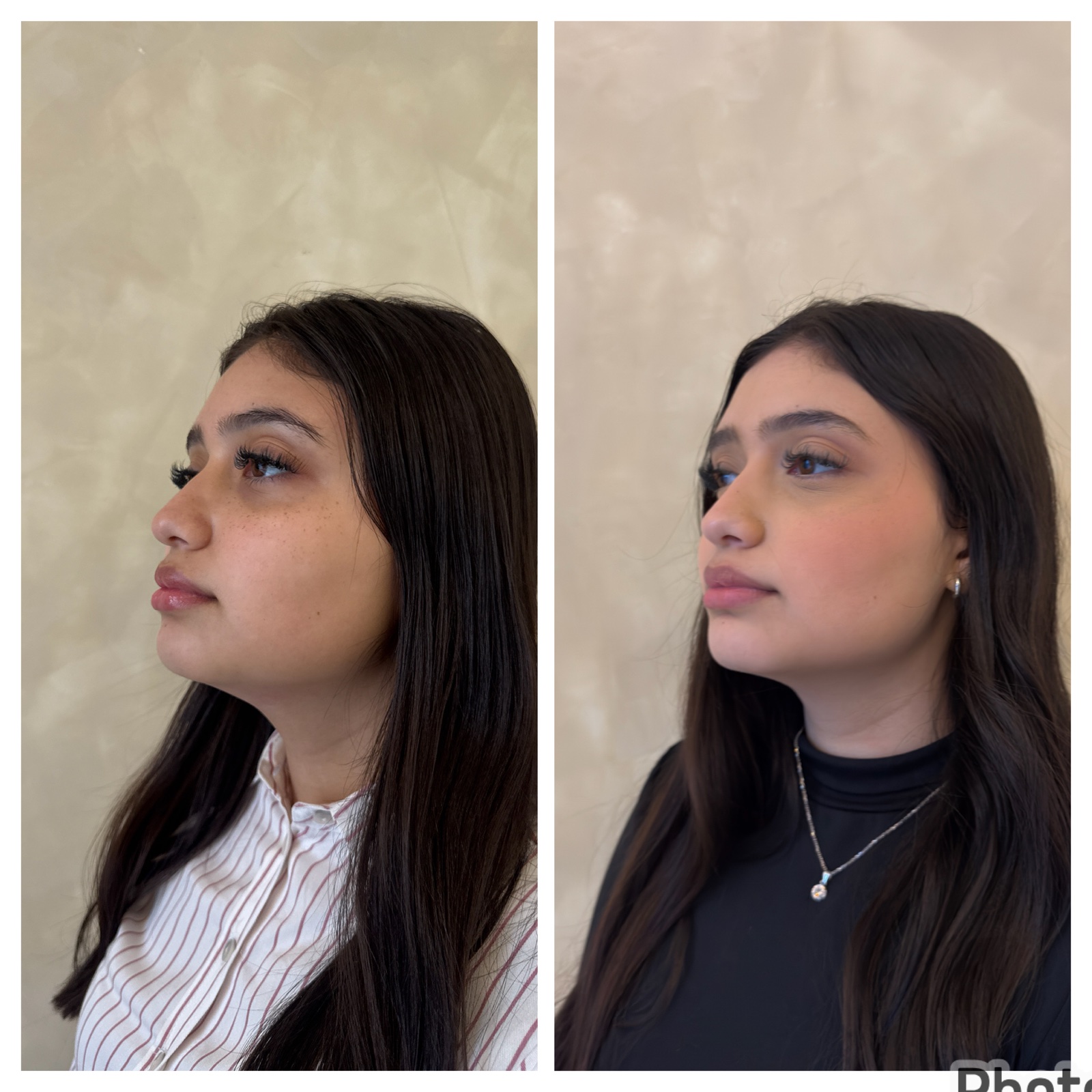 Comparação de antes e depois em vista de perfil, registro 4, fornecida pela Dra. Luiza Ohanna